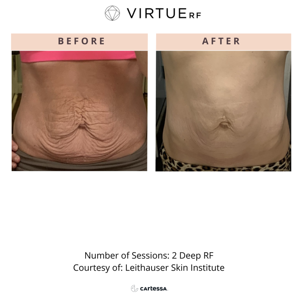 VirtueRF for body Before & After