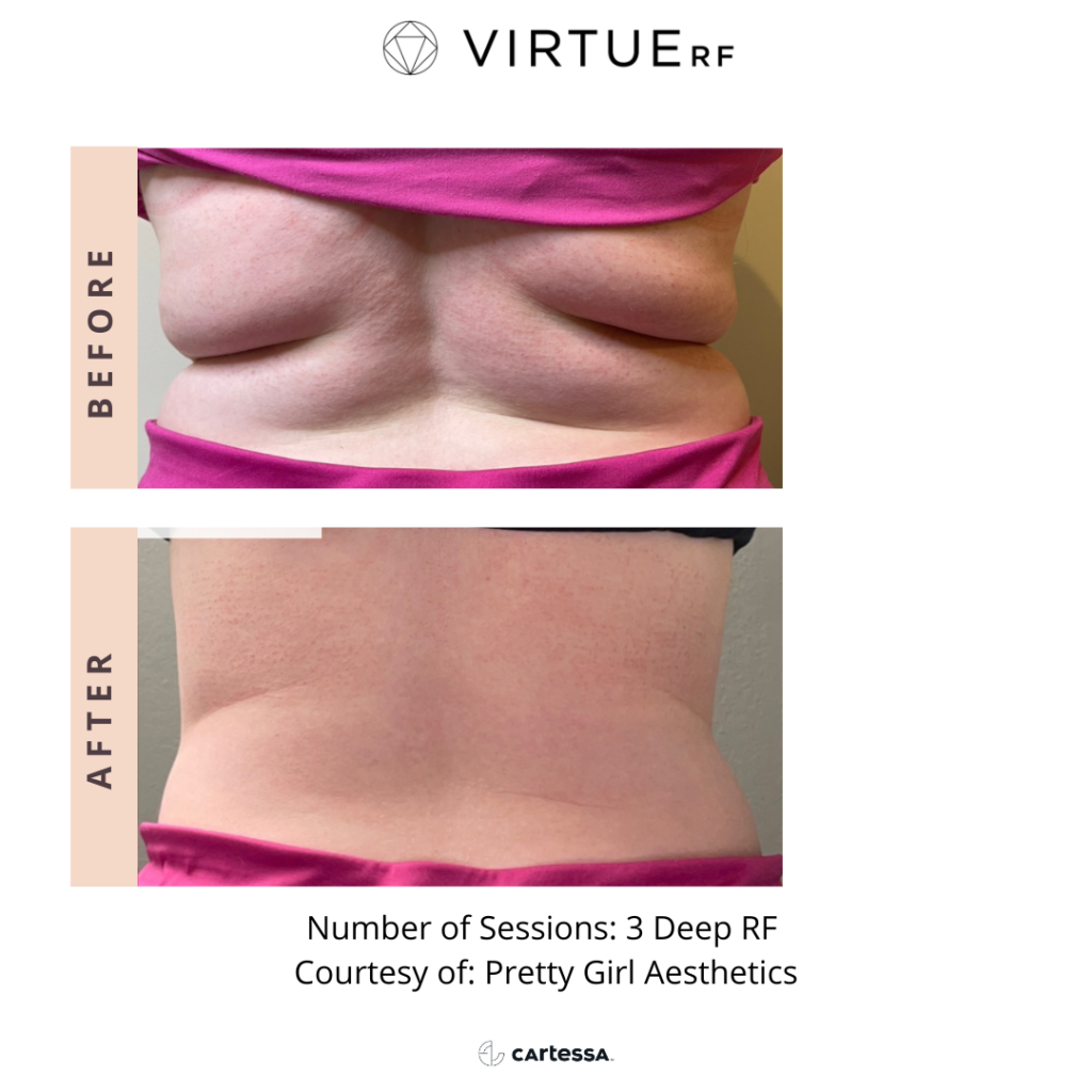 VirtueRF for body Before & After