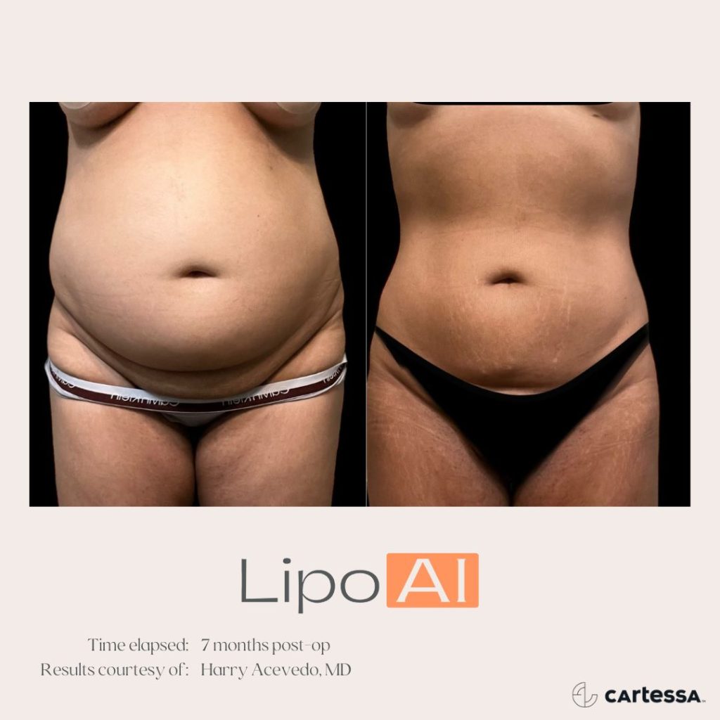 LipoAI Before & After