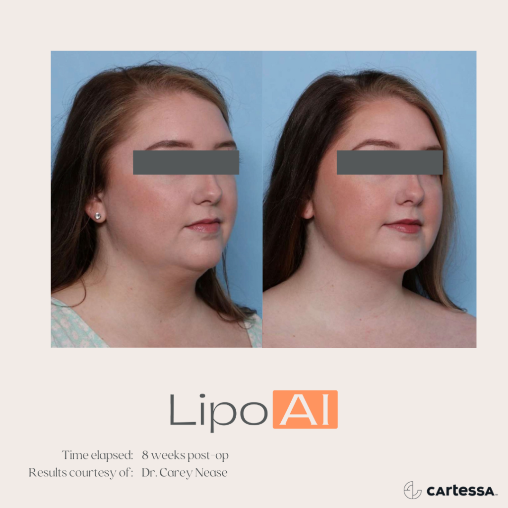 LipoAI Before & After