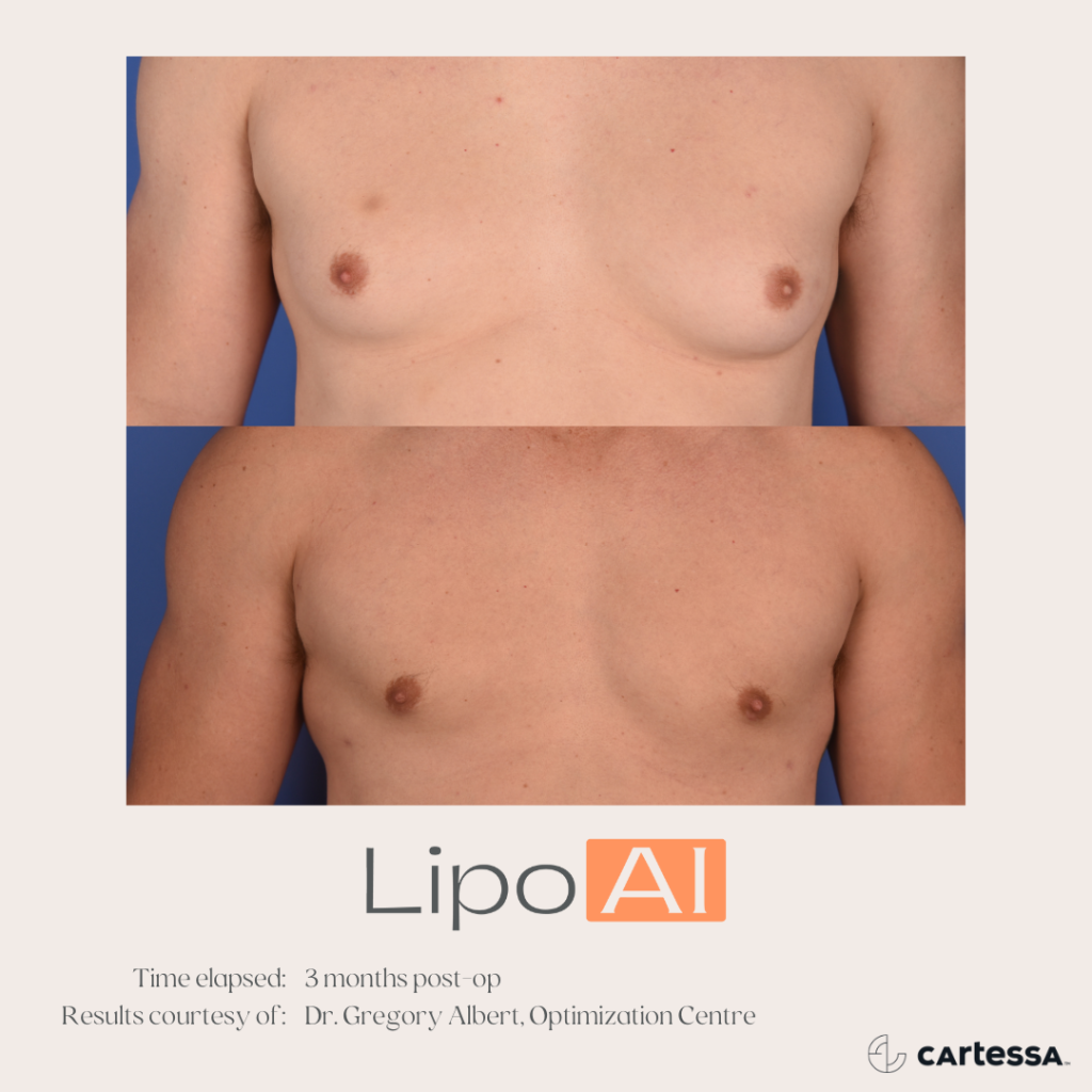 LipoAI Before & After