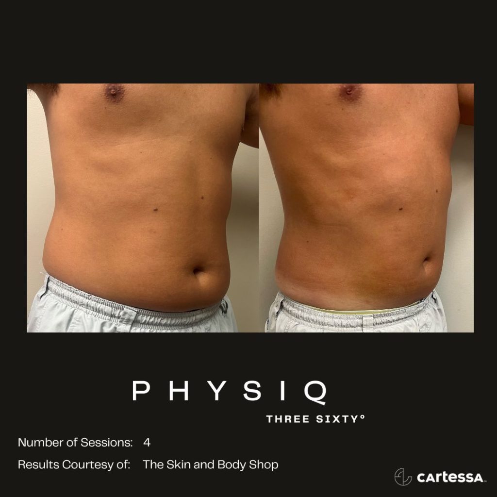 Physiq 360 Before & After on Male