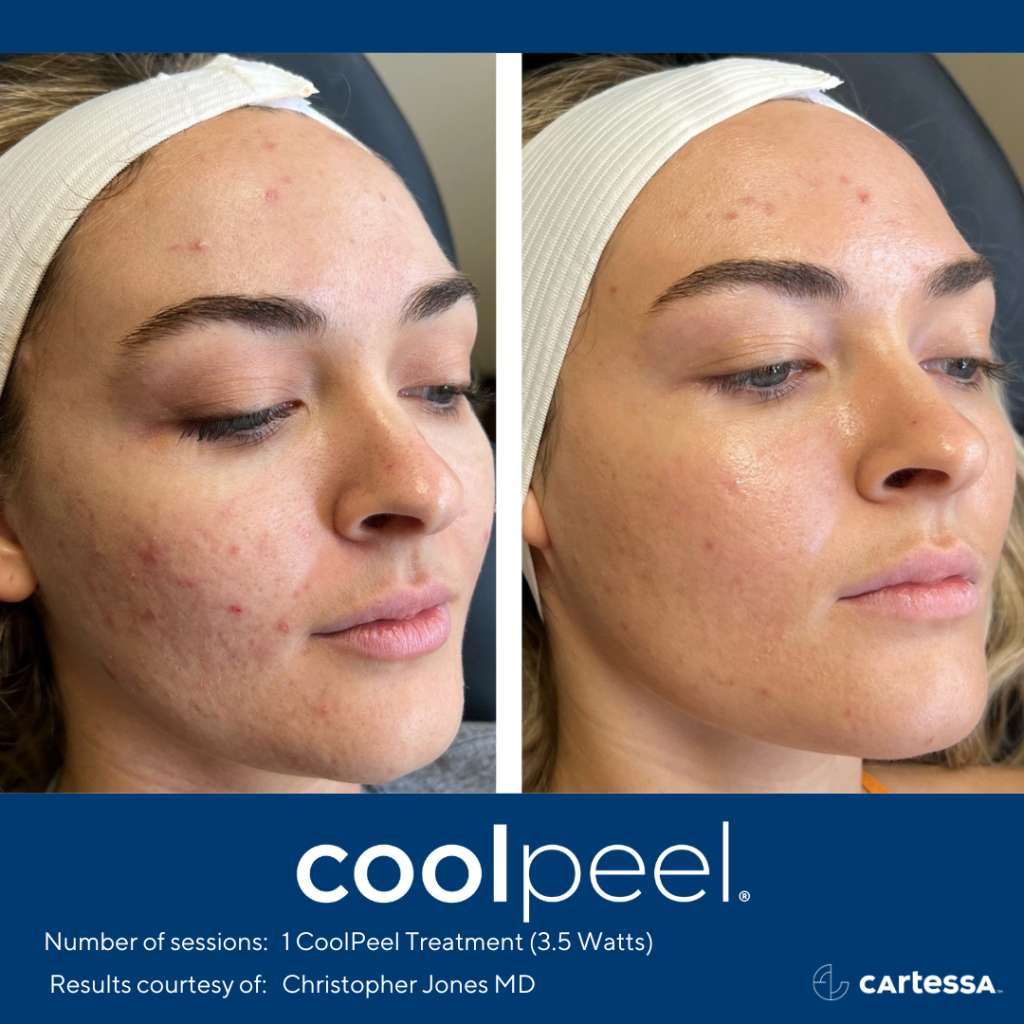 CoolPeel Before and After