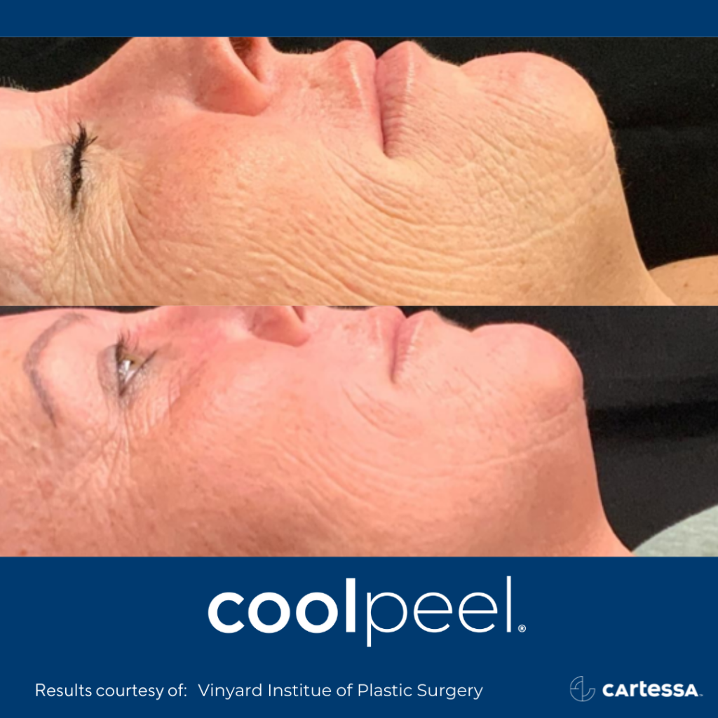 CoolPeel Before and After