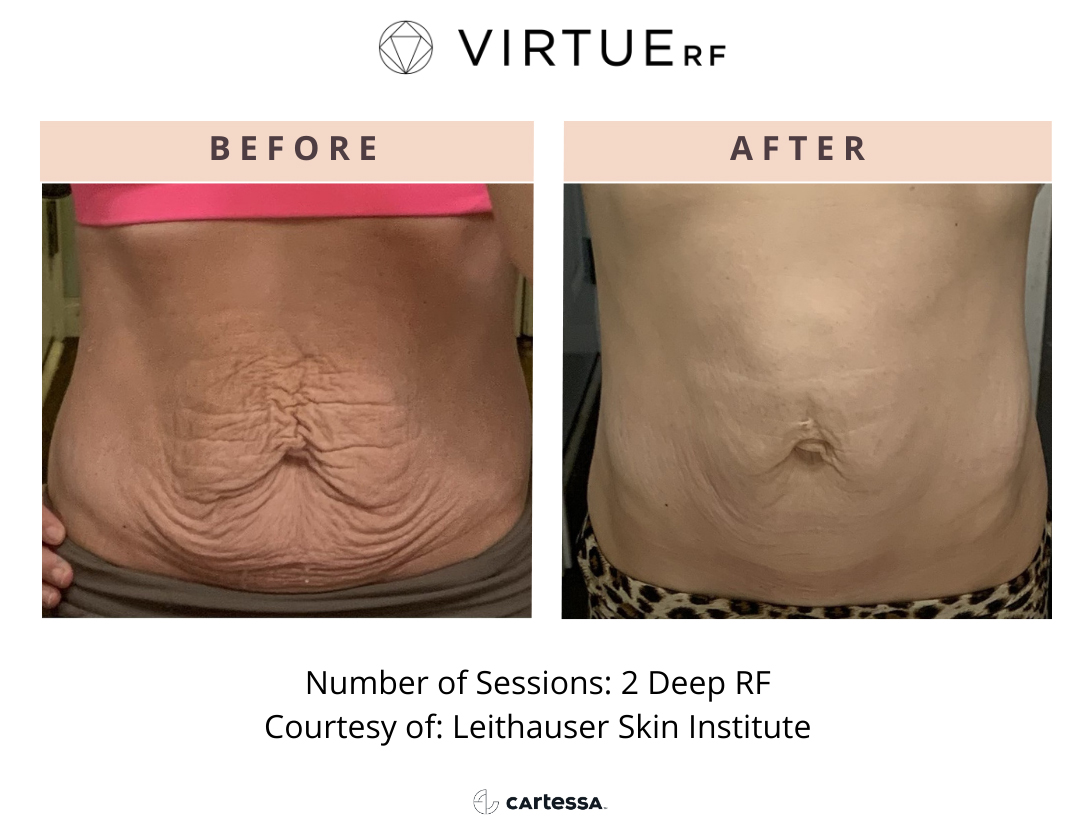 VirtueRF for body Before & After